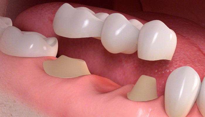 Close up shot of three dental bridged being fixed on the area of the missing teeth.