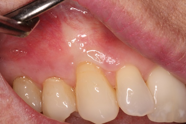 A dentist (face not seen) examines an inflamed upper gum.