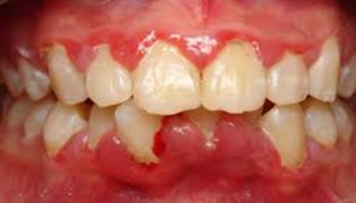 Image of an inflamed lower gum