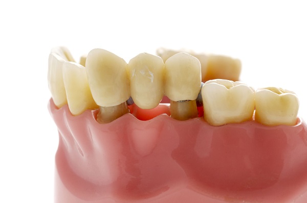 Dental bridges are being fit on the area of the three missing teeth. 