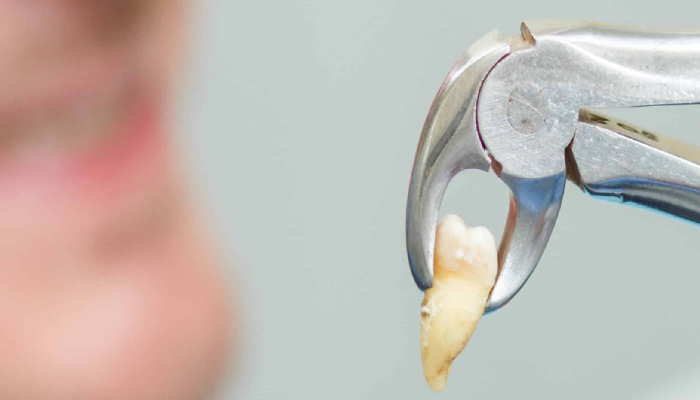 A tooth is taken out from the mouth with the help of teeth extractor.
